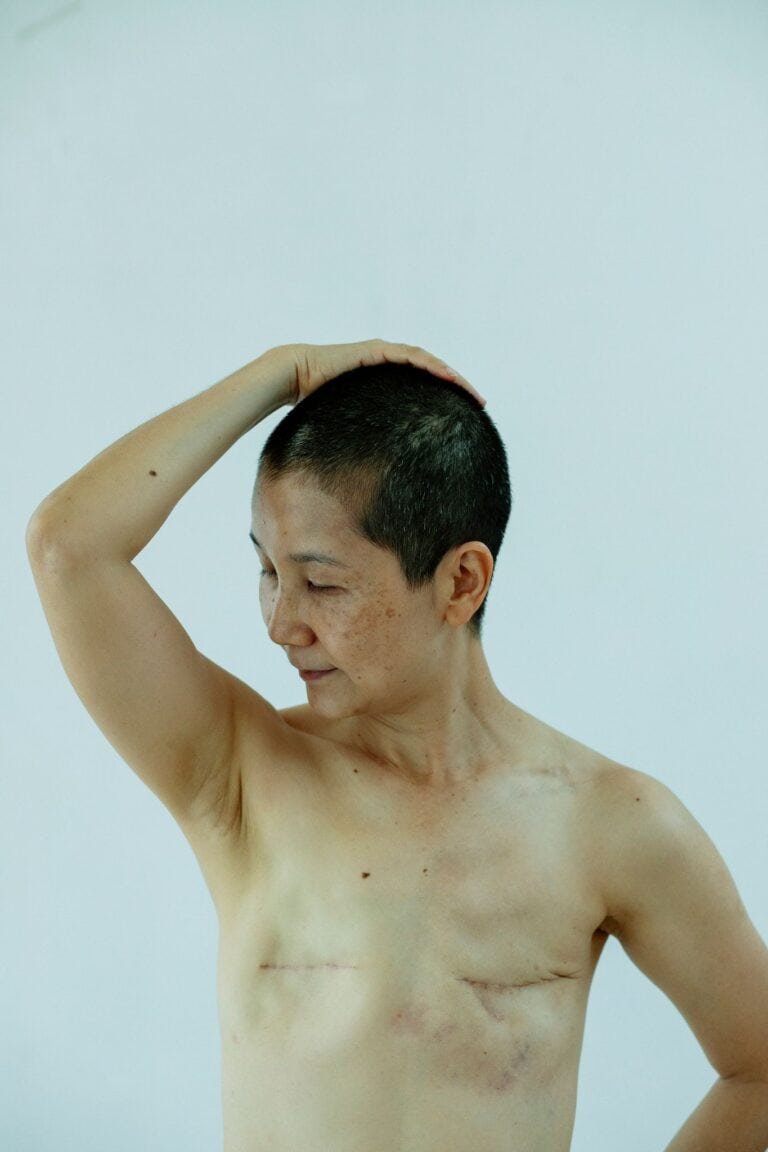 Ethnic topless female with short hair and scars after surgery on white background of studio